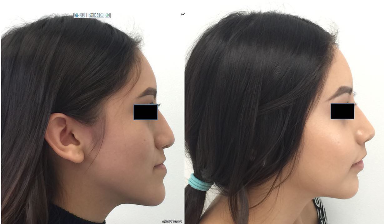 Jaw Feminization