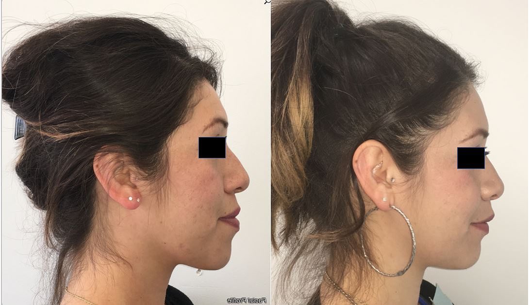 Jaw Feminization